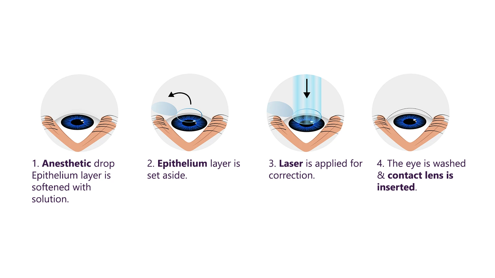 What is LASIK Treatment