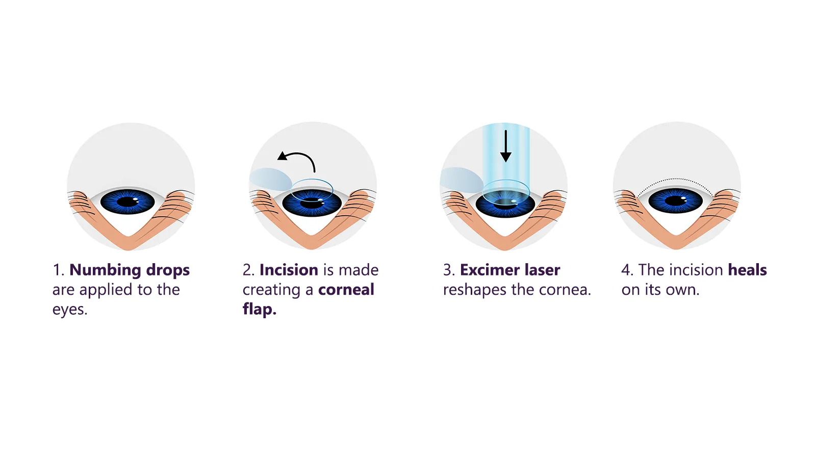 What is LASEK Treatment