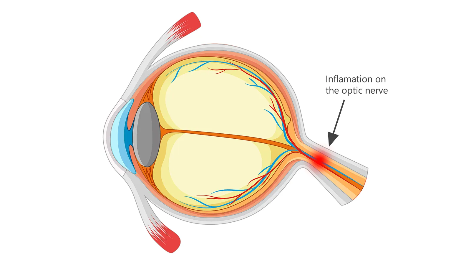 What is Optic Neuritis