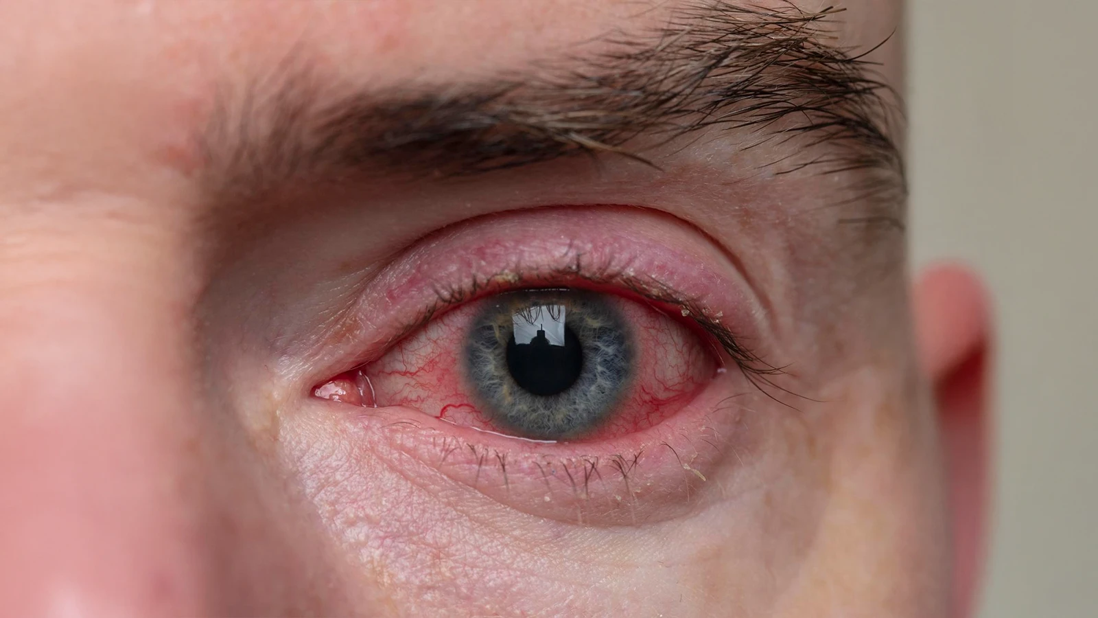 Eye Cold Symptoms