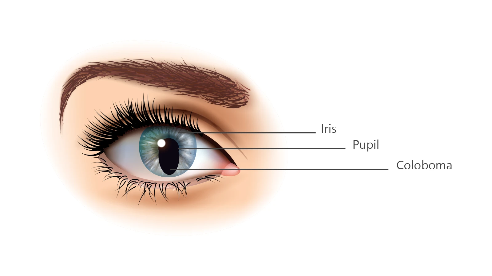 Does Coloboma Affect Vision