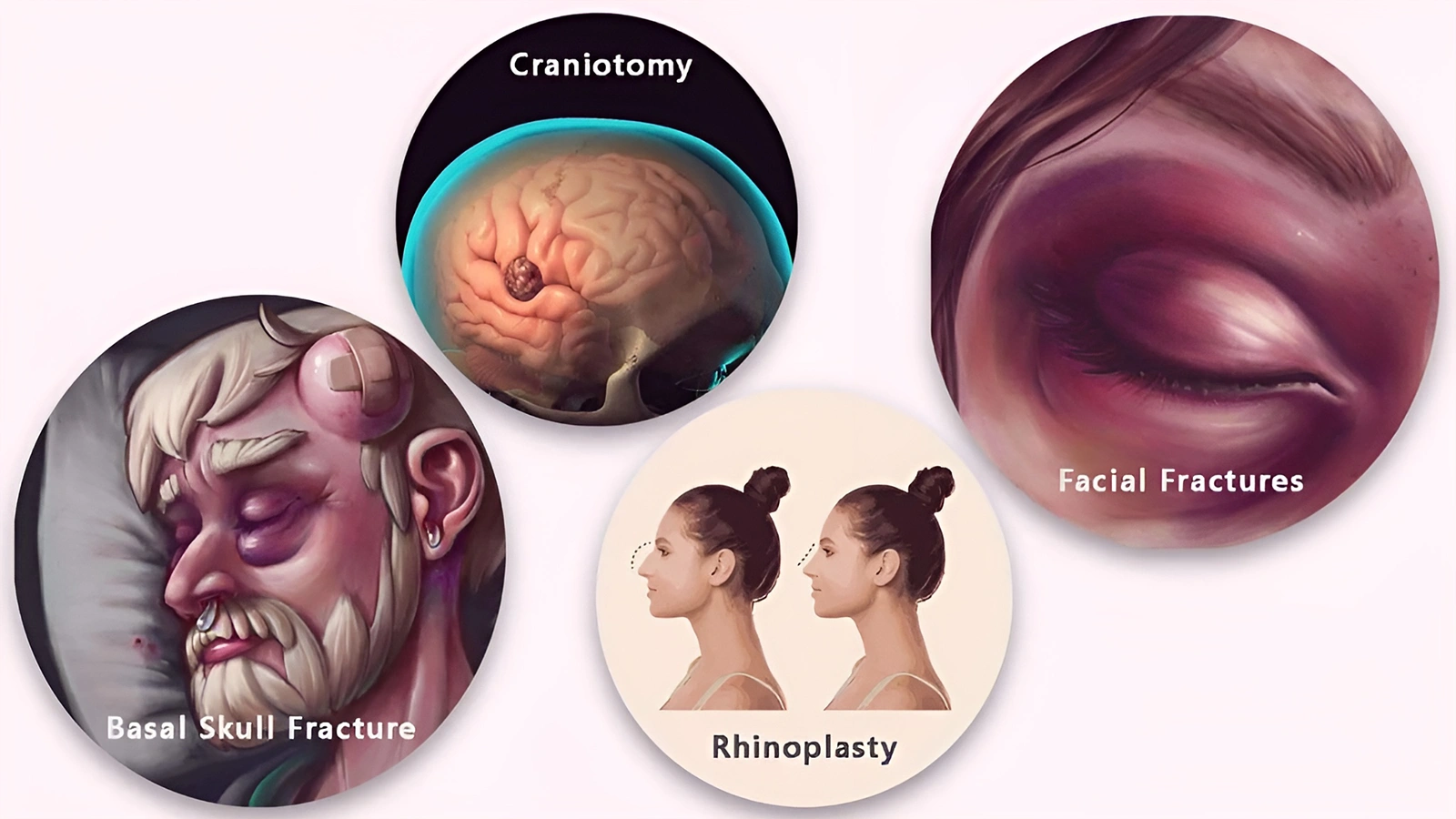 What Causes Raccoon Eyes