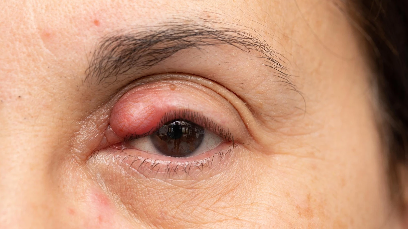 What is blepharitis?