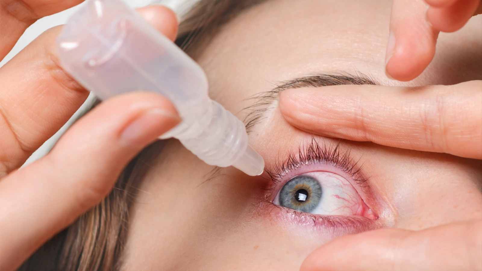 Blepharitis Treatment