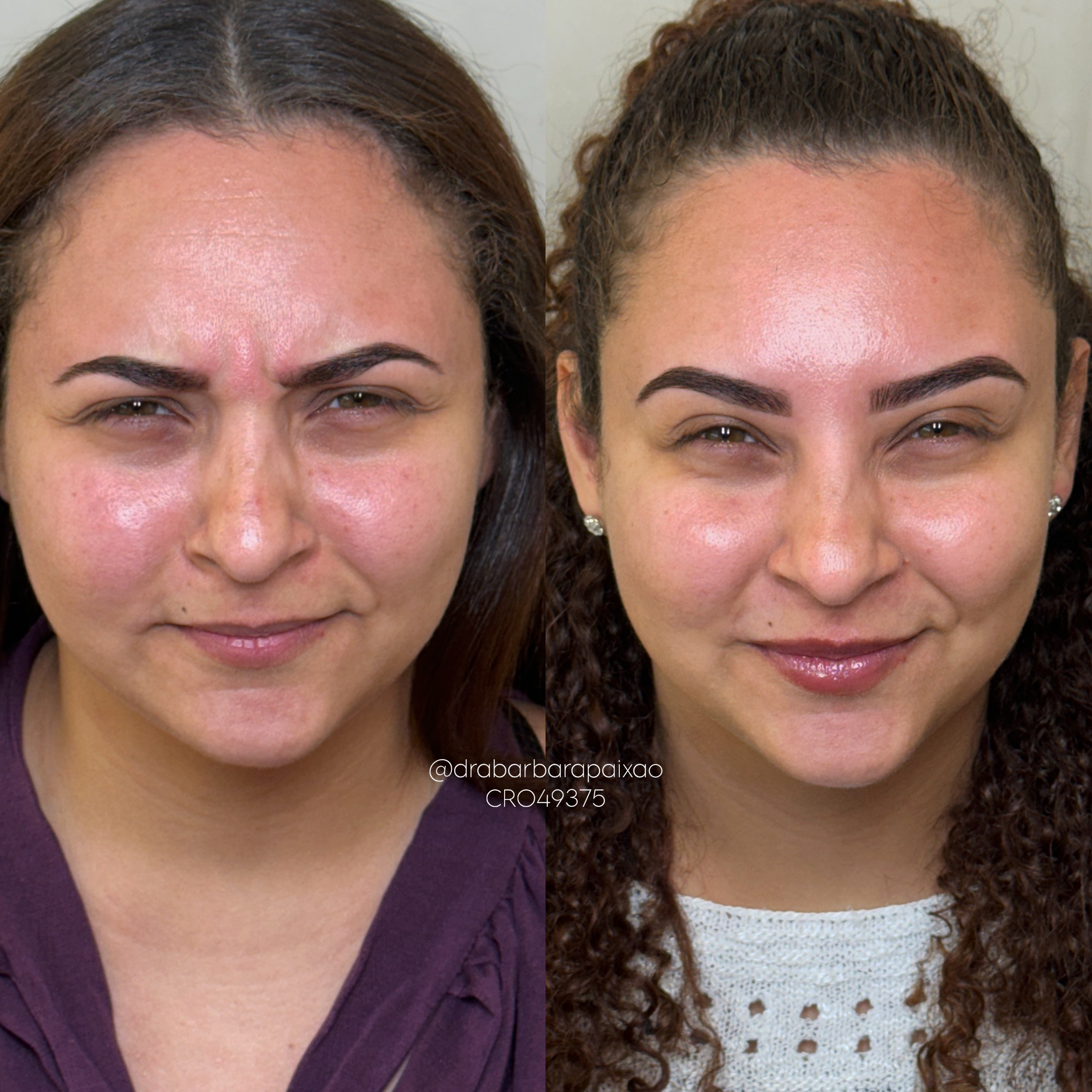 Perfiloplastia