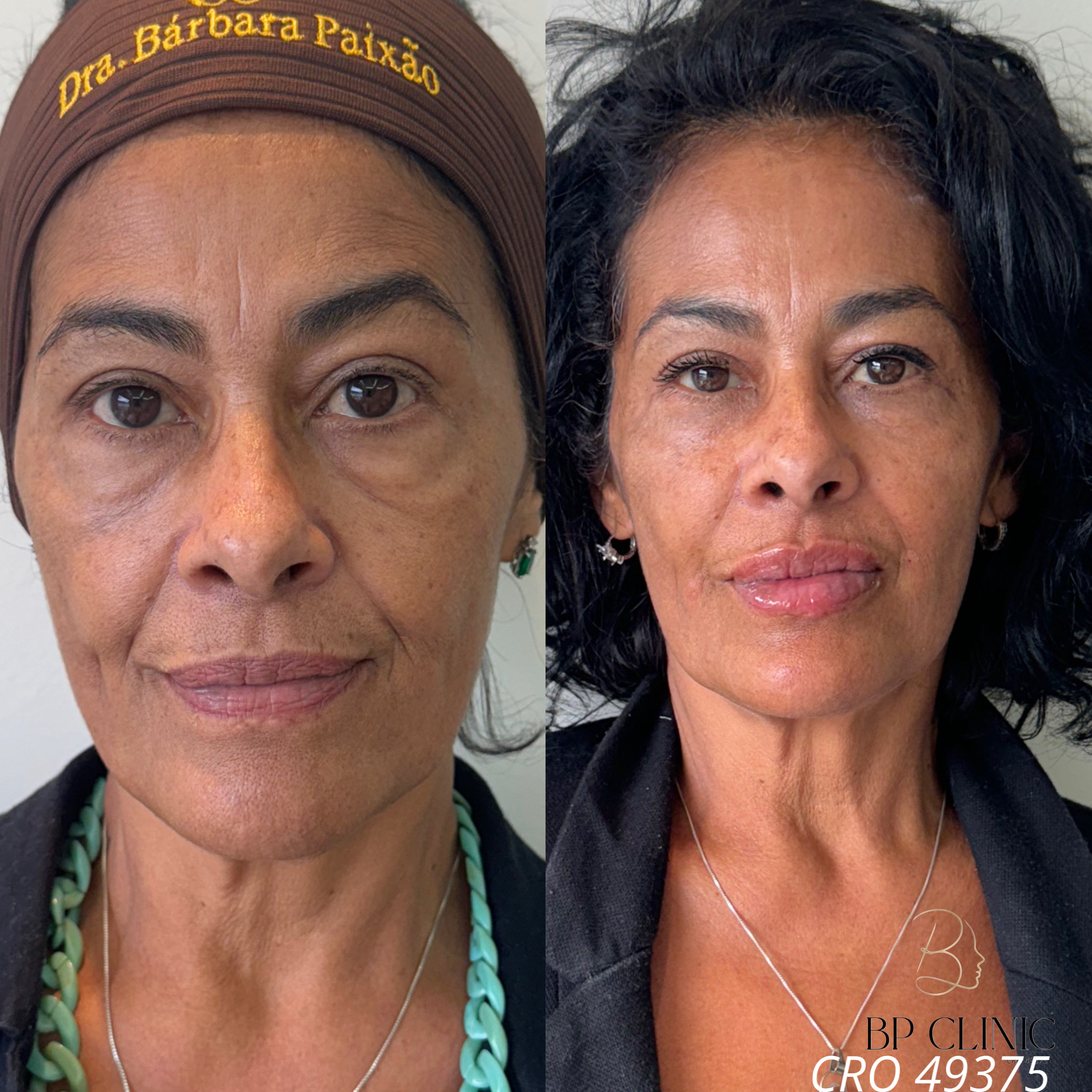 Botox