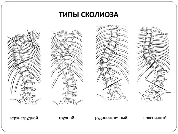 Льюис сейр лечение сколиоза фото