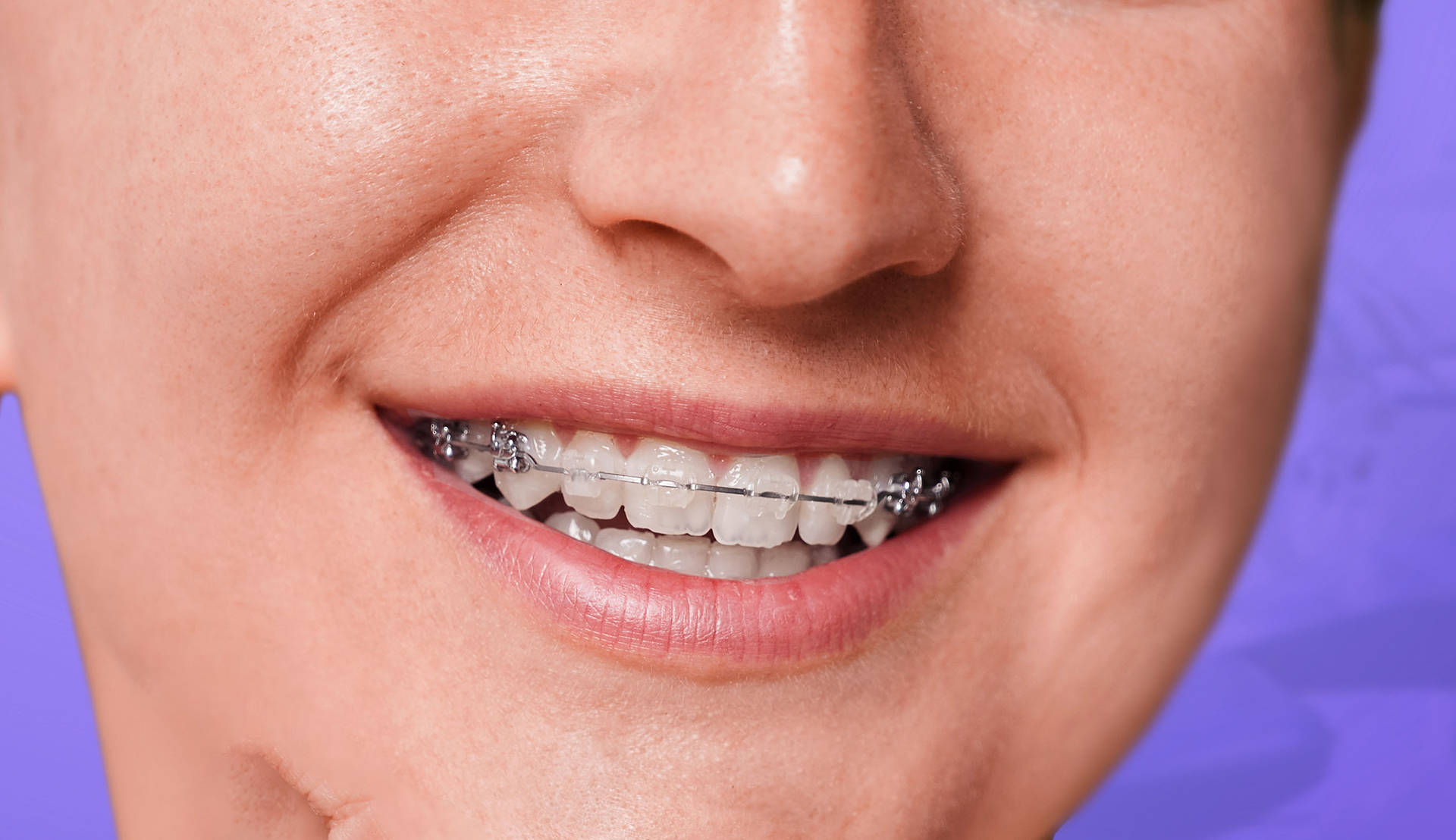 Ceramic Braces