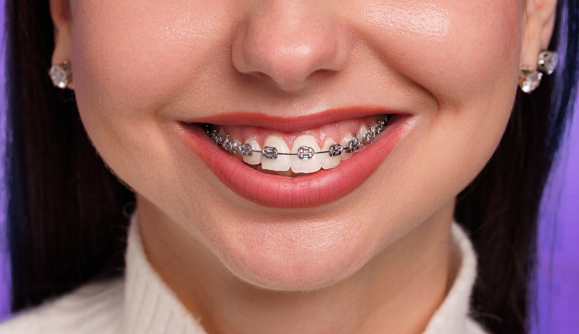 Self-ligating Braces
