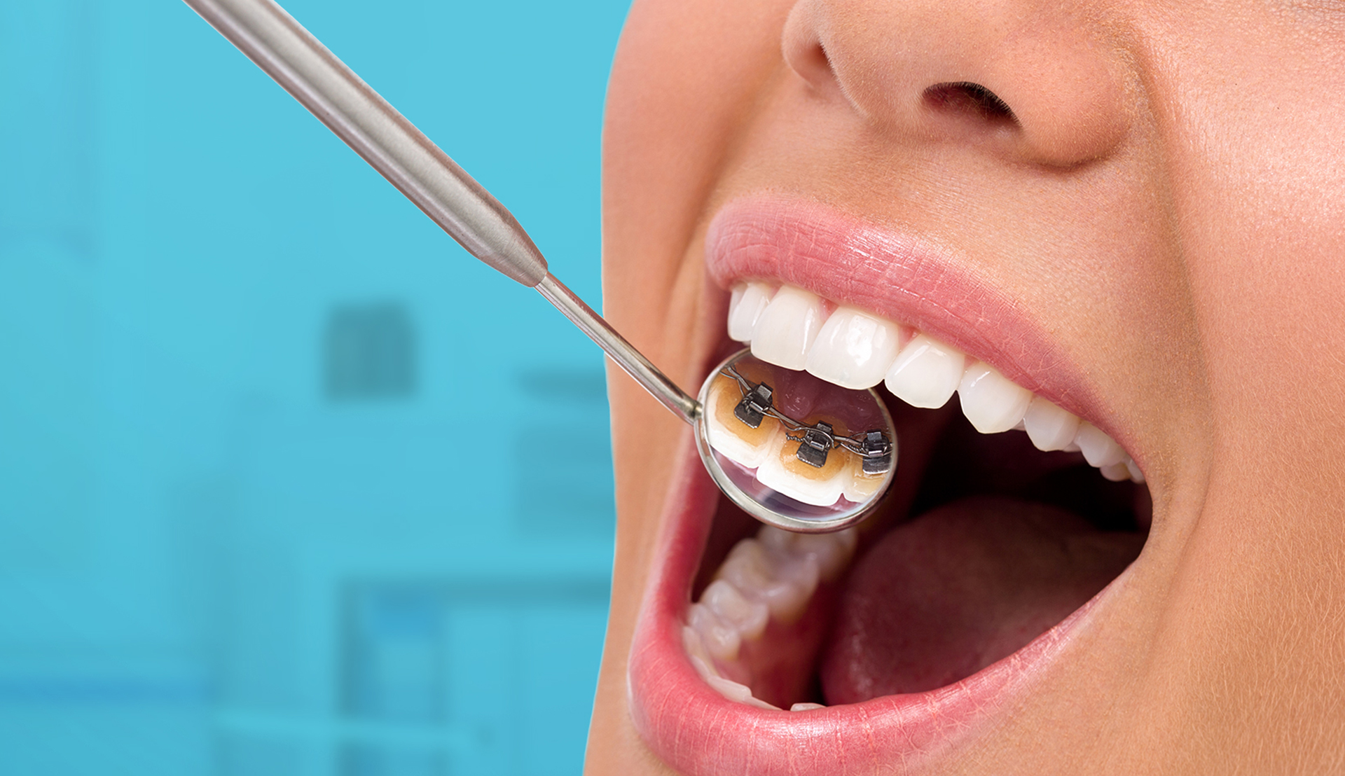 Lingual Braces