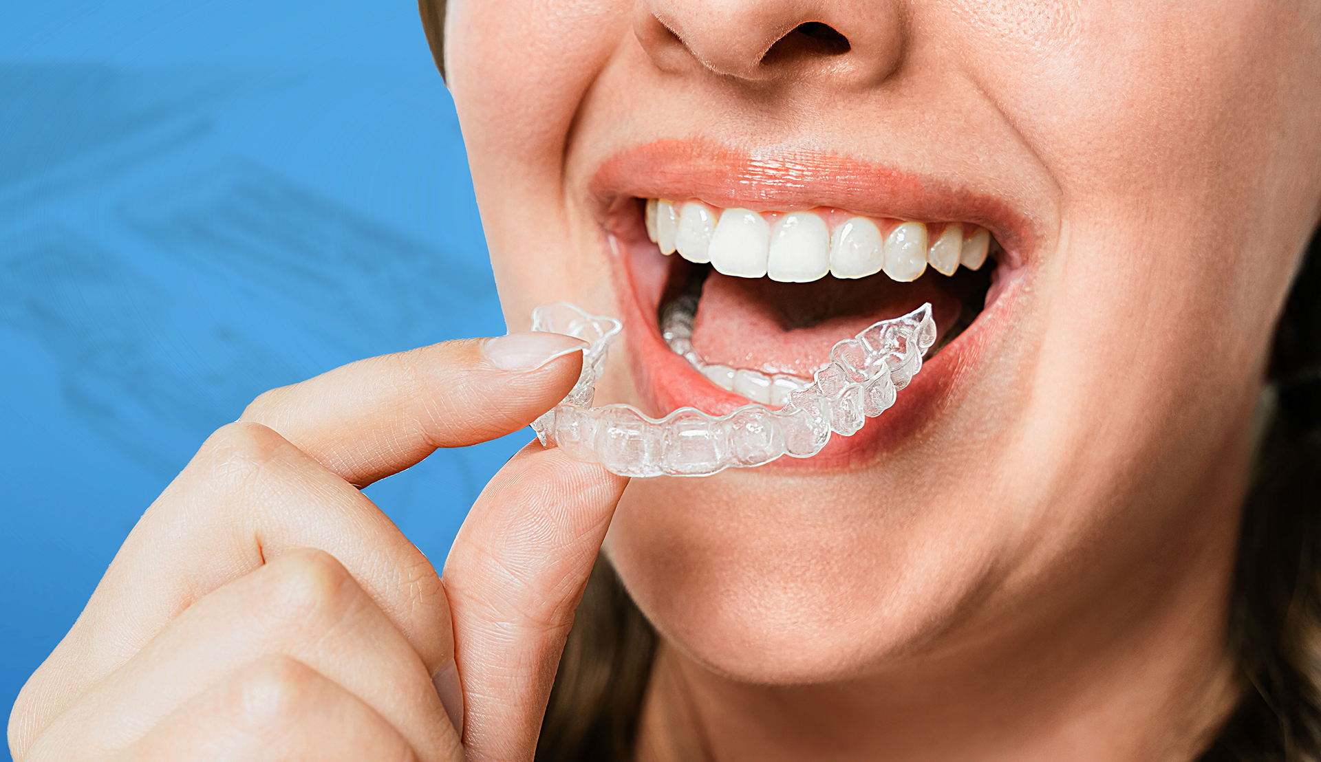 Clear Aligners