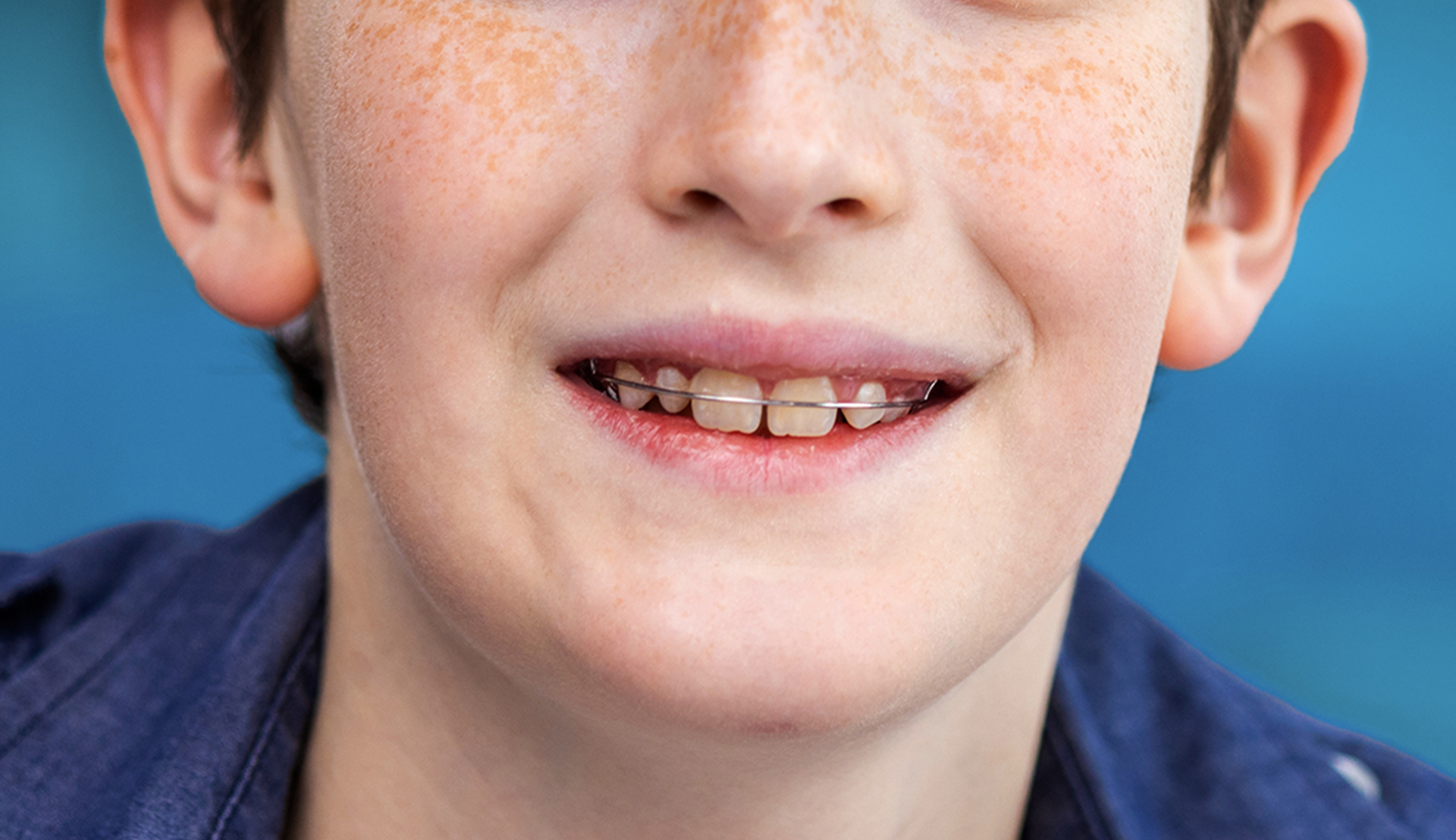Retainers