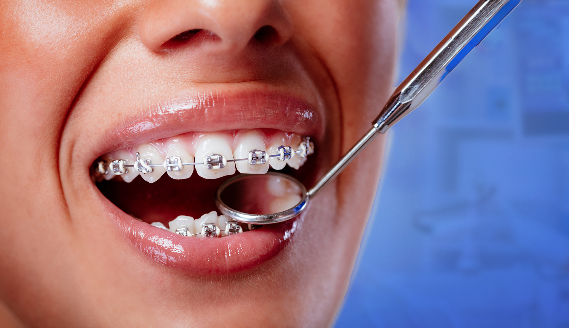 Metal Braces