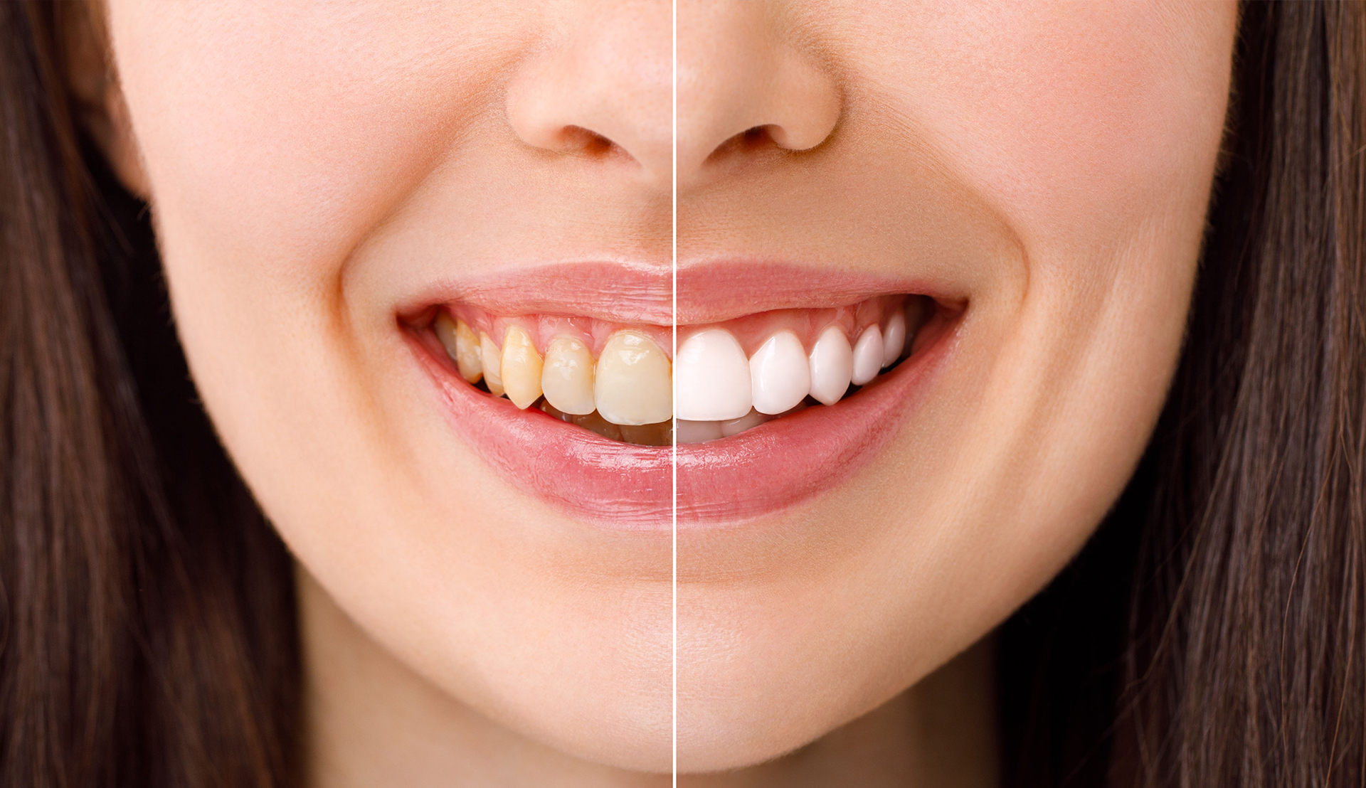 Teeth Whitening