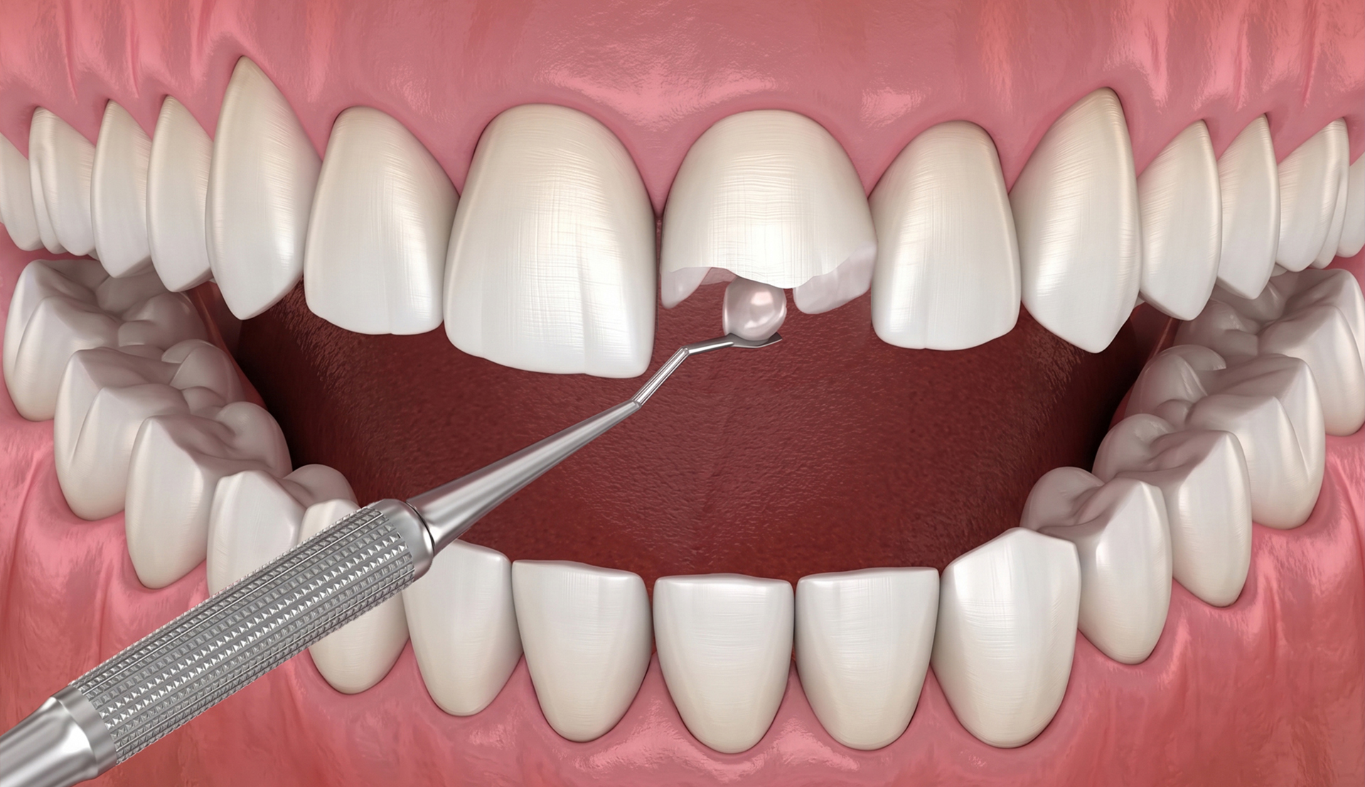 Aesthetic Fillings