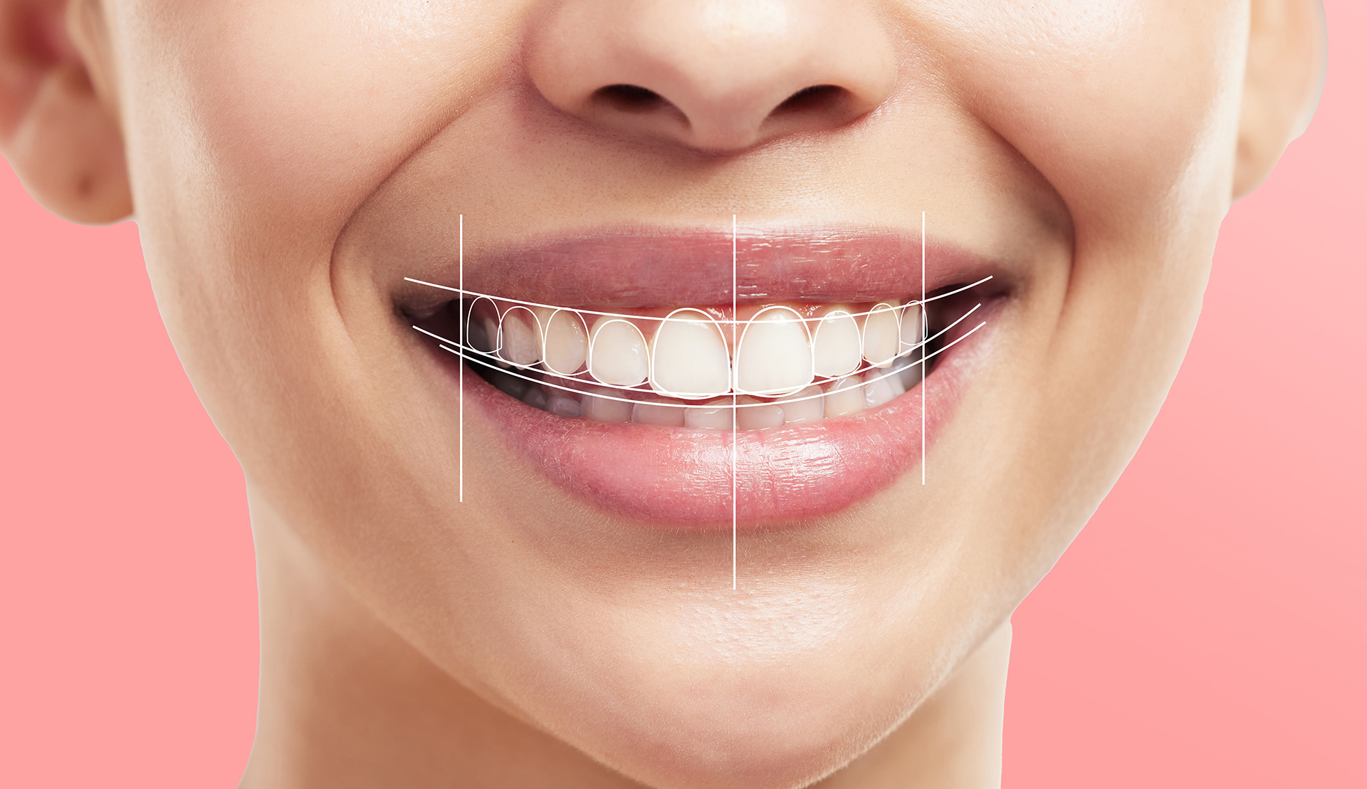 Smile Design