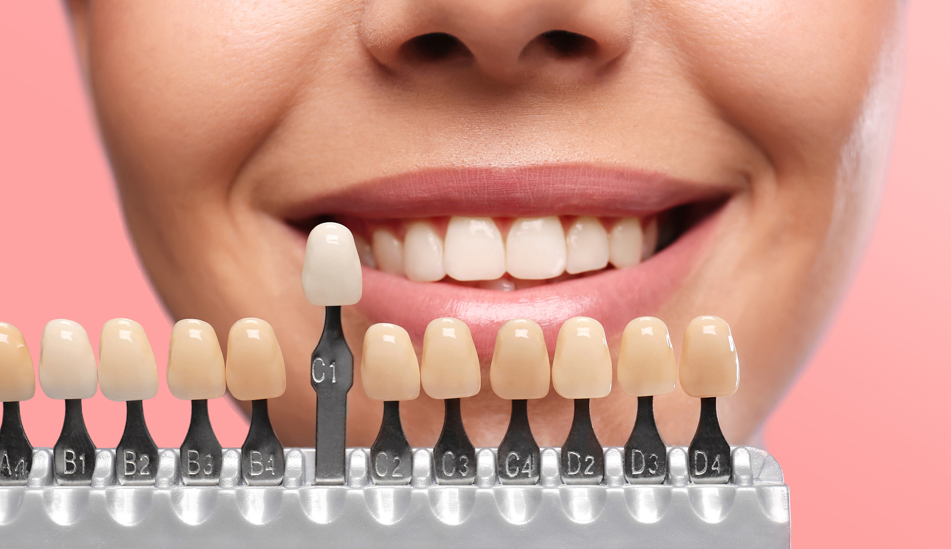 Composite Veneers