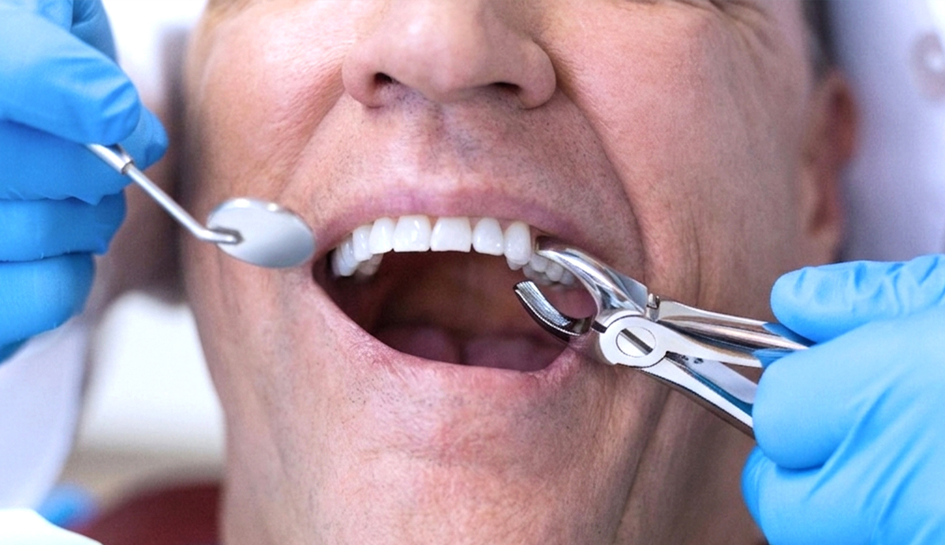 Tooth Extraction