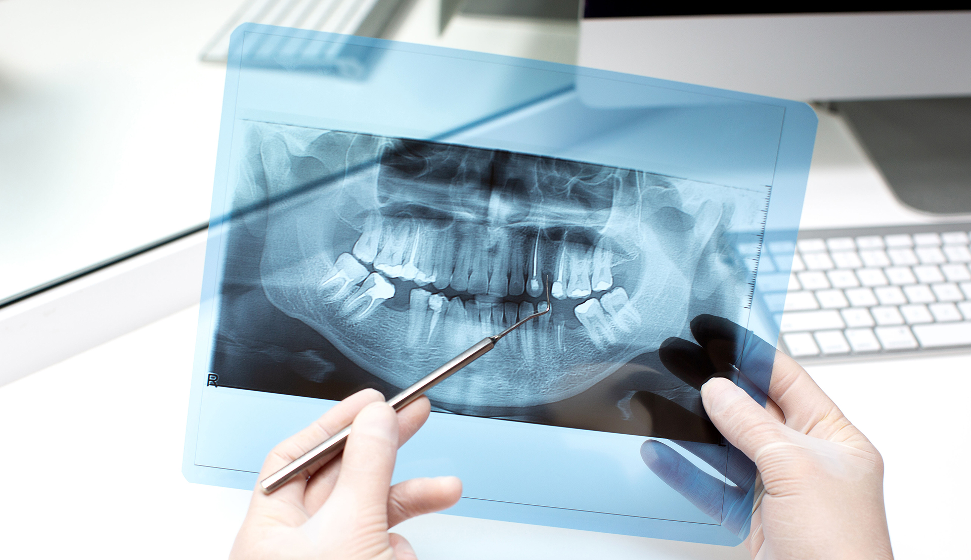 OPG and CBCT
