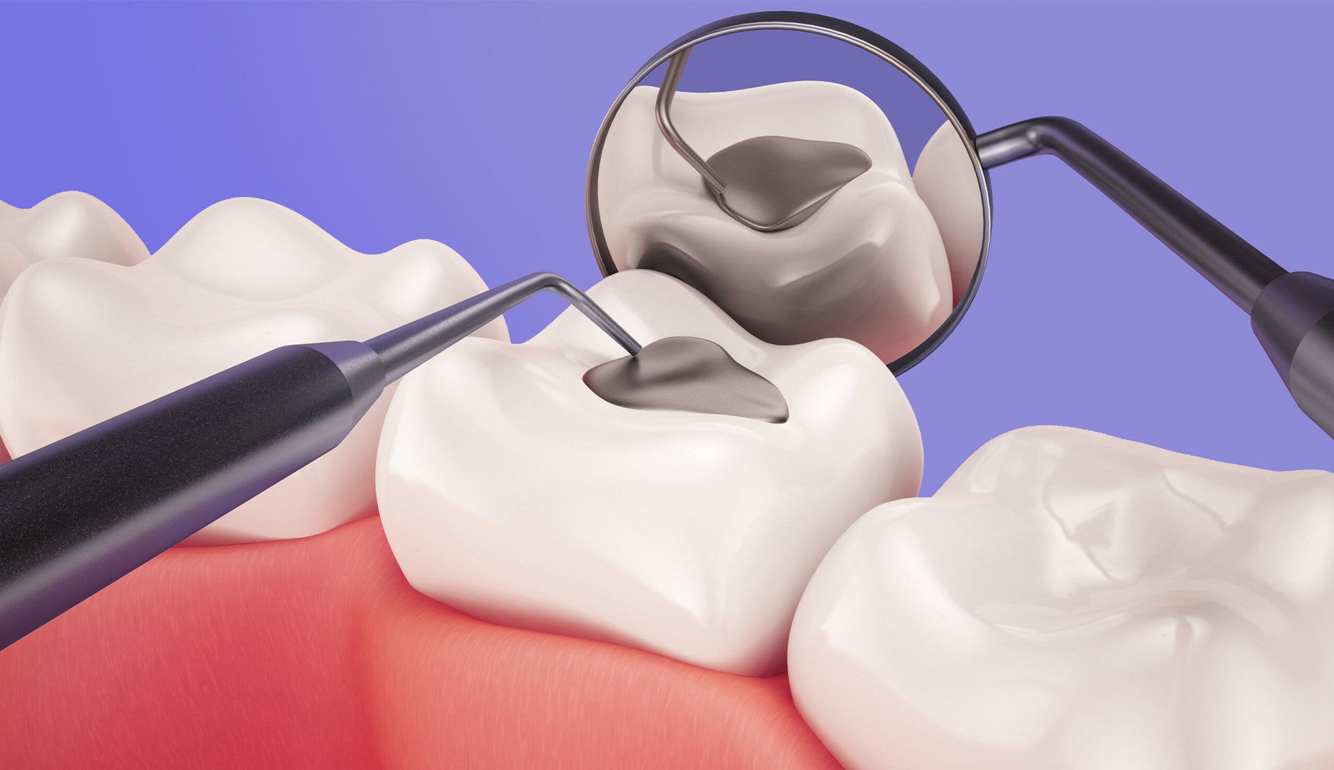 Dental Fillings