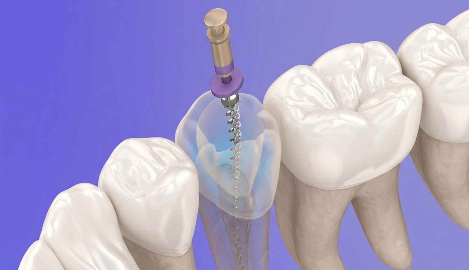 Pulpectomy/Pulpotomy