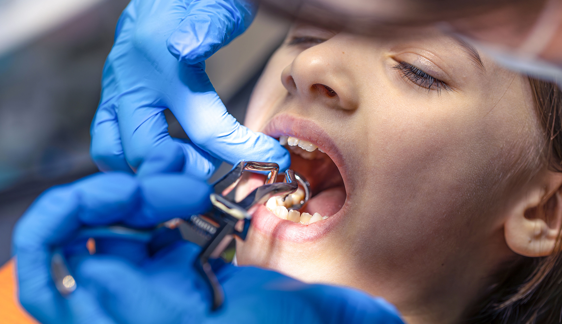 Tooth Extractions