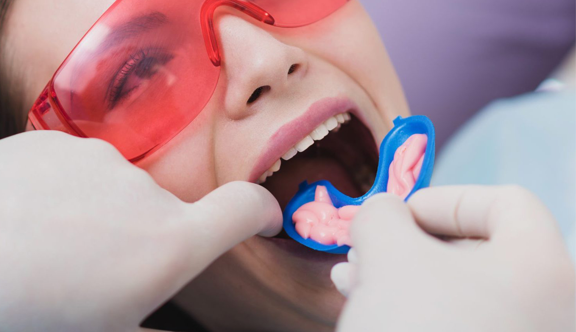 Fluoride Treatment