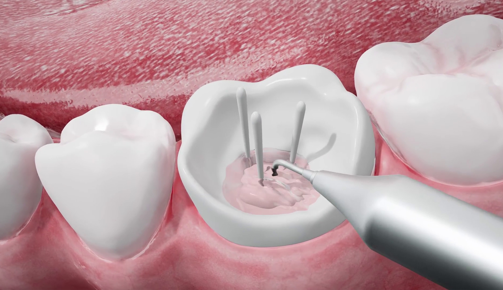 Root Canal Retreatment