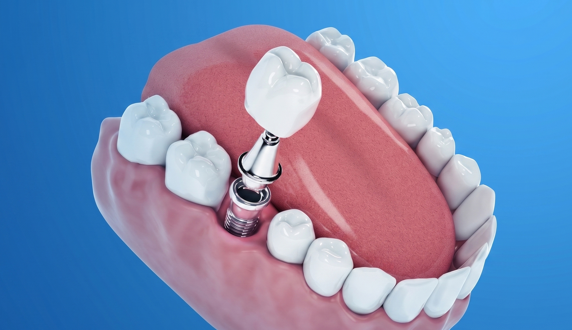 Tooth Implant