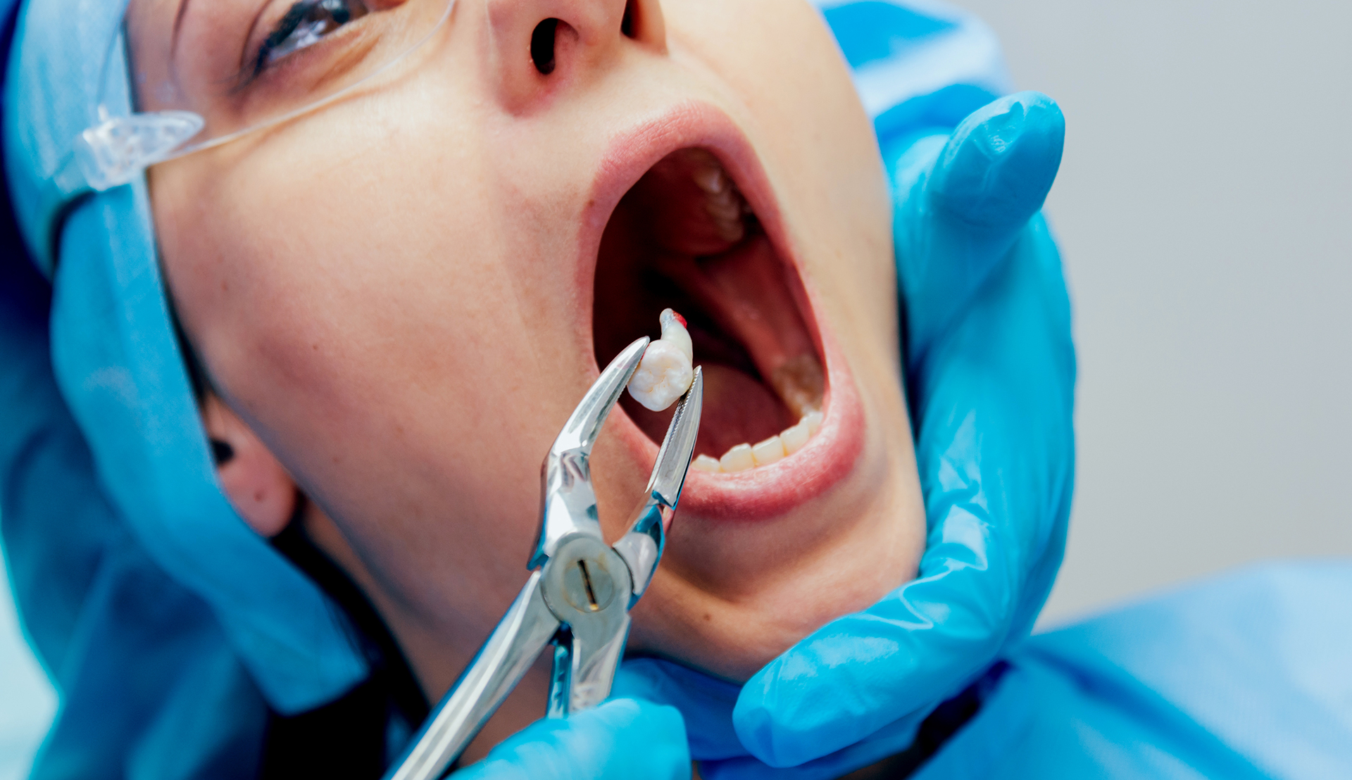 Wisdom Tooth Surgery