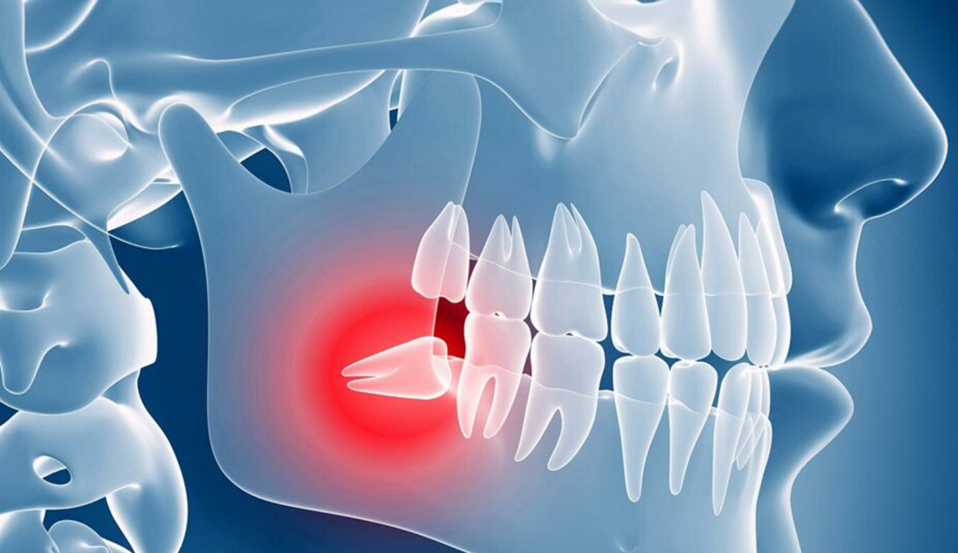 Impacted Tooth Surgery