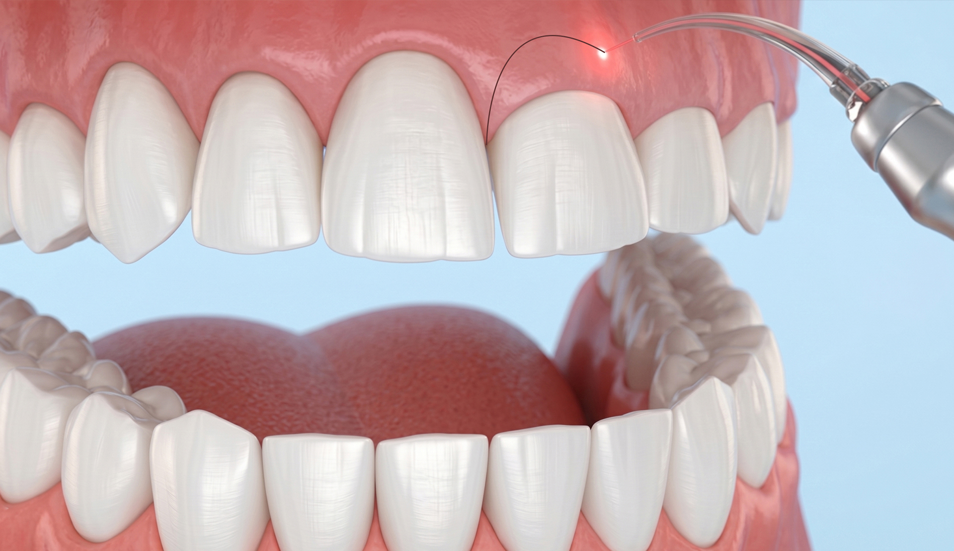 Gingivectomy