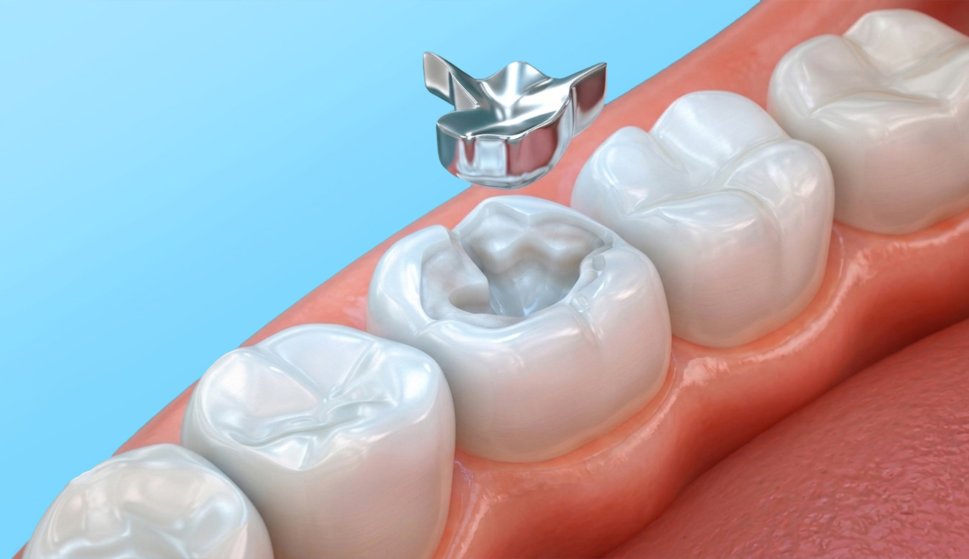 Teeth Filling