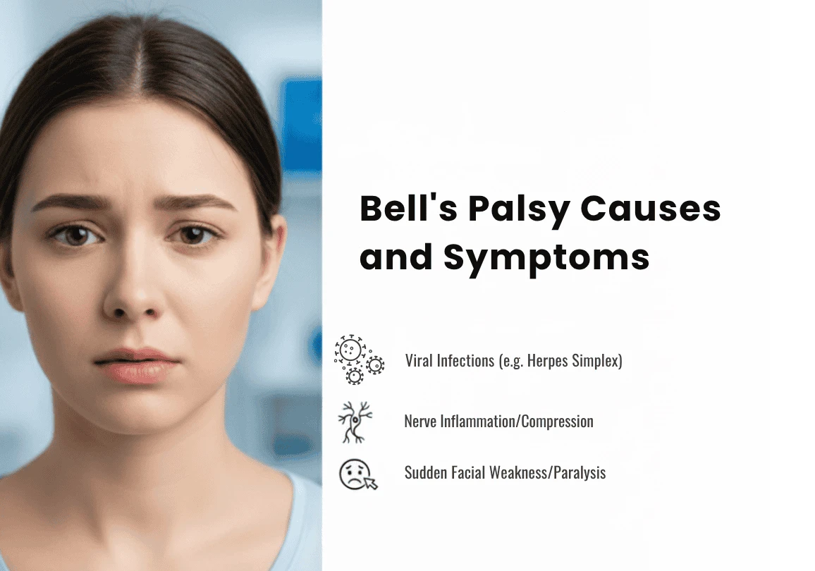 Bells Palsy causes