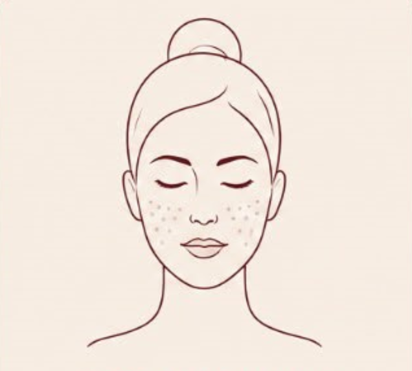 Post-Acne Marks