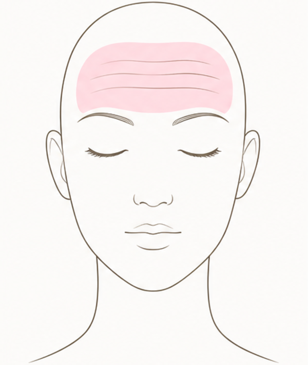 Forehead Lines