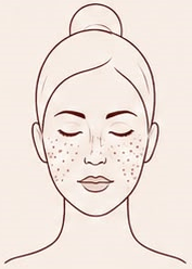 Freckles