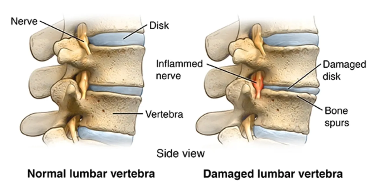What Does Spinal Fusion Mean?