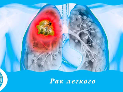Рак легкого