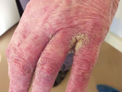 Пензенские медики показали как выглядит женщина, страдающая от норвежской чесотки