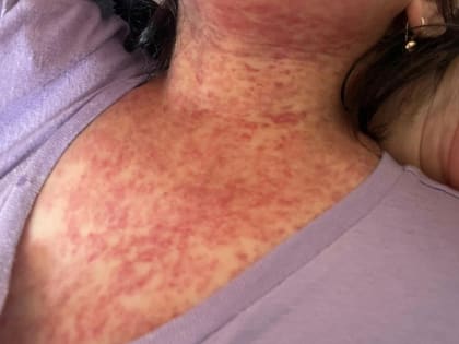 Вспышка кори в Пензенской области: число заболевших продолжает расти