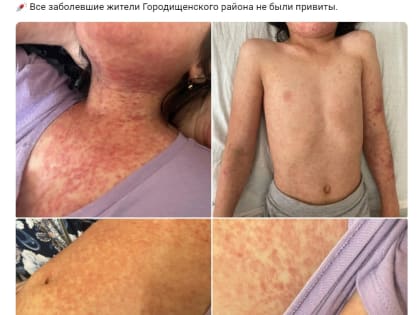 Пензенцам показали снимки детей, изуродованных смертельной корью