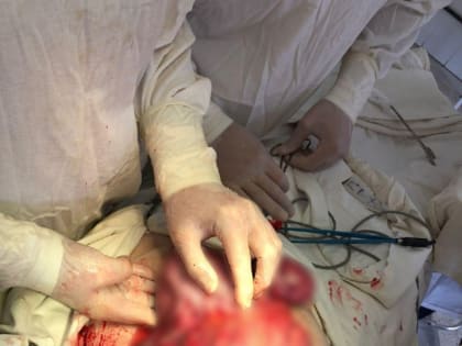 Энгельсские хирурги удалили у пациентки 8-килограммовую опухоль