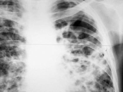 В саратовский тубдиспансер вернули самовольно ушедшую пациентку