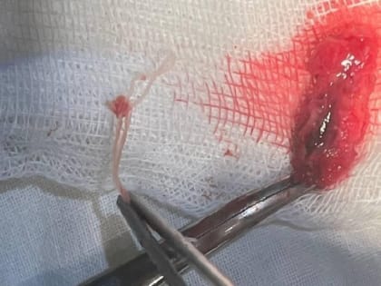 А во лбу гельминт сидит. В Саратове врачи вырезали червя из лица пациента