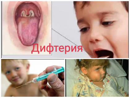 Медики напоминают о профилактике дифтерии