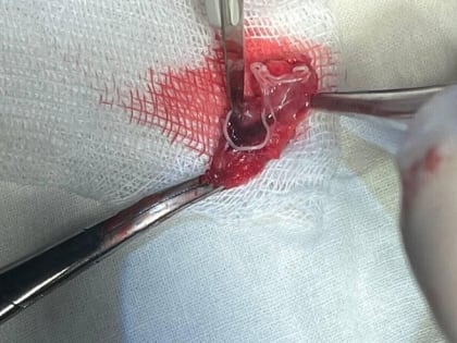 Из головы саратовца хирурги вытащили 12-сантиметрового живого червя