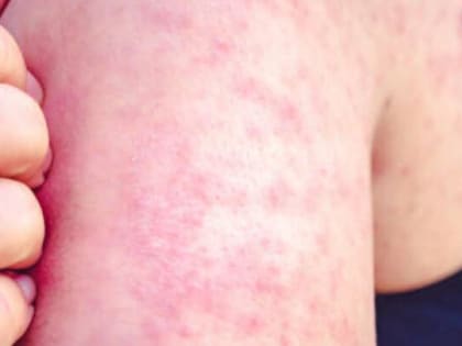 Саратовцев предупреждают об опасности заражения корью