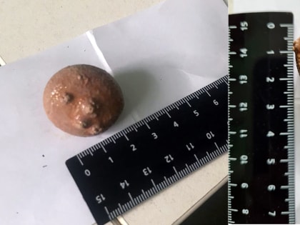 Доктор Сарайкин из Балаково извлек из пожилого мужчины камень диаметром три сантиметра