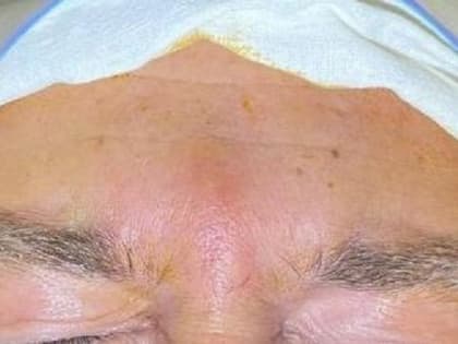 Саратовские врачи достали гельминта из лица пациента